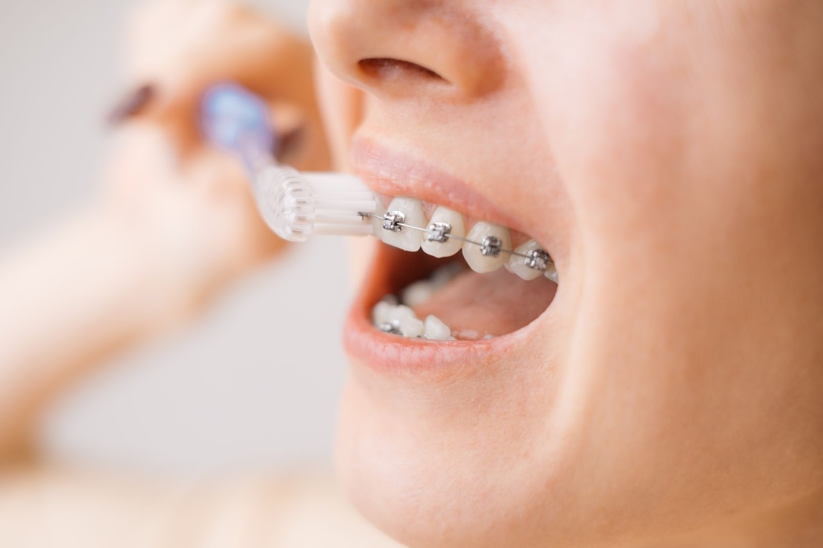 Brushing Tips for Braces Patients